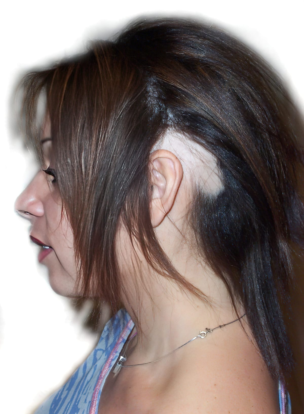 Before Picture - Alopecia Areata
